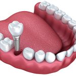 Kinh Nghiệm Trồng Răng Implant Từ Lúc Bắt Đầu Tới Khi Kết Thúc