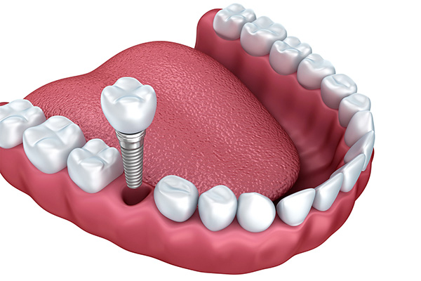 CAY GHEP implant