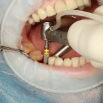 Trồng răng Implant có bị hôi miệng không? Nguyên nhân, cách xử lý