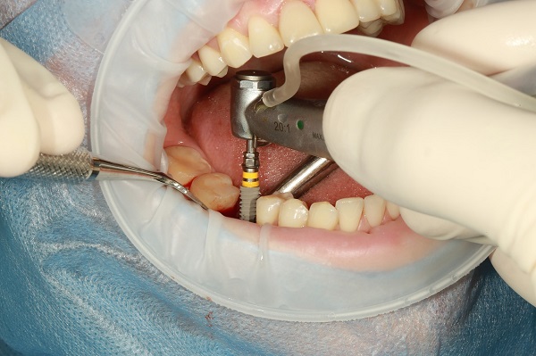 Trồng răng implant 