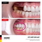 Phương pháp thực hiện trồng răng Implant