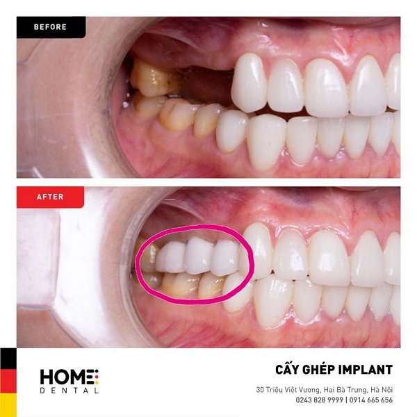 Nên cấy ghép Implant ở đâu tốt?