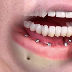 Trồng răng implant có mất quá nhiều thời gian không?