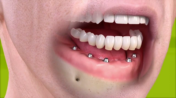 Phương pháp thực hiện trồng răng Implant