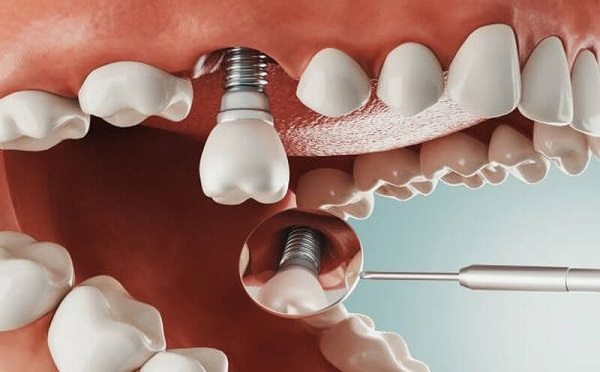 Trồng răng Implant có bị hôi miệng không