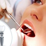 Khi nào nên thực hiện nâng xoang ghép xương trước khi cấy ghép Implant