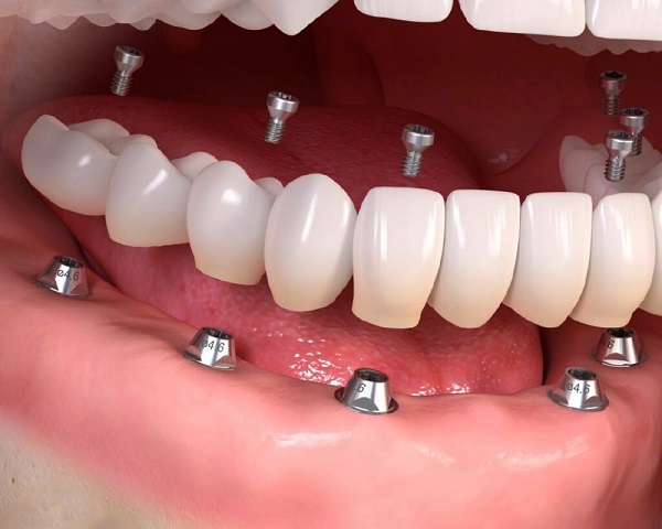 Trồng răng implant có mất quá nhiều thời gian không