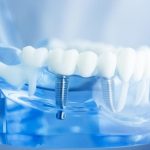 Trồng răng implant có mất quá nhiều thời gian không?