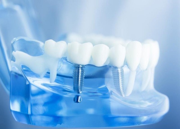 Trồng răng implant mất thời gian bao lâu thì lành?