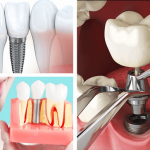 Răng implant tồn tại bao lâu?Hướng dẫn cách kéo dài tuổi thọ cho răng