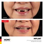 Top 7 biến chứng sau khi thực hiện cấy ghép implant