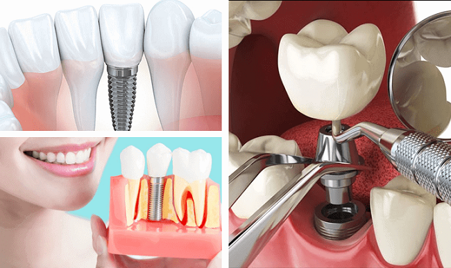 Trồng răng Implant có bền không? Tuổi thọ của răng Implant là bao lâu?