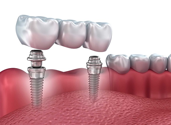 dental-implants