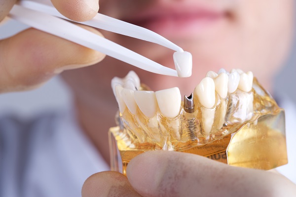 Răng implant tồn tại bao lâu?Hướng dẫn cách kéo dài tuổi thọ cho răng