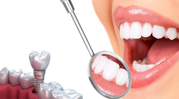 Khi nào trồng Implant là tốt nhất?