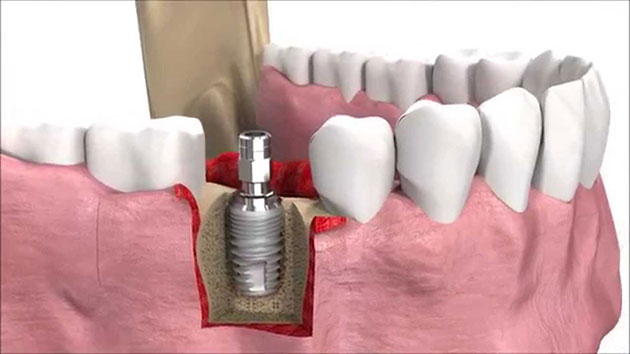 ky-thuat-trong-rang-implant