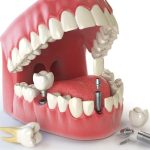 Khi nào nên thực hiện nâng xoang ghép xương trước khi cấy ghép Implant