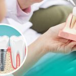 Khi nào trồng Implant là tốt nhất?