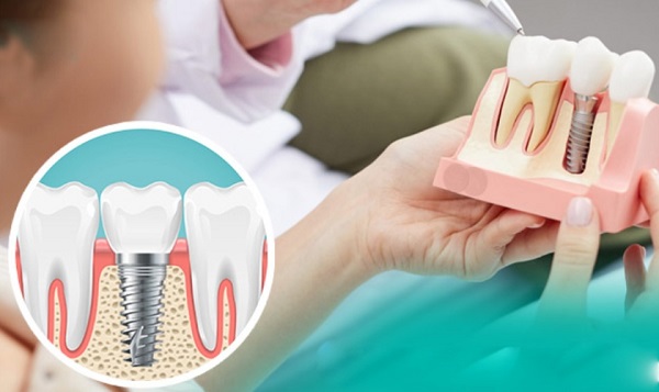 Khả năng tài chính thấp có thể trồng Implant được không?