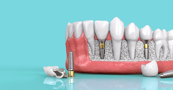 Khả năng tài chính thấp có thể trồng Implant được không?