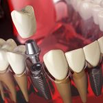 Chườm ấm sau khi trồng răng implant có tác dụng như thế nào?