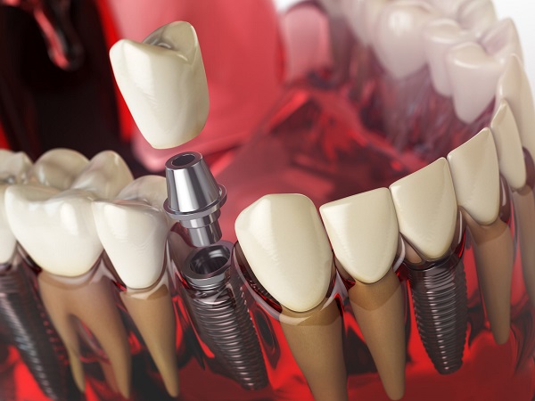 Một số các lưu ý sau khi thực hiện cấy ghép Implant để đảm bảo hiệu quả lâu dài