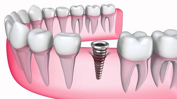 trong-rang-implant (2)