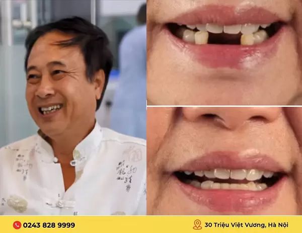 Trồng răng implant cho người già