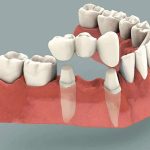 Kinh Nghiệm Trồng Răng Implant Từ Lúc Bắt Đầu Tới Khi Kết Thúc