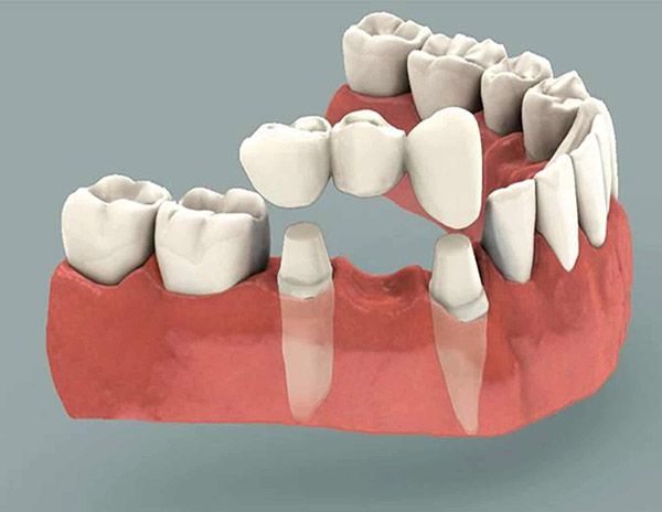 Cấy ghép implant mất bao thời gian để tích hợp xương hàm?