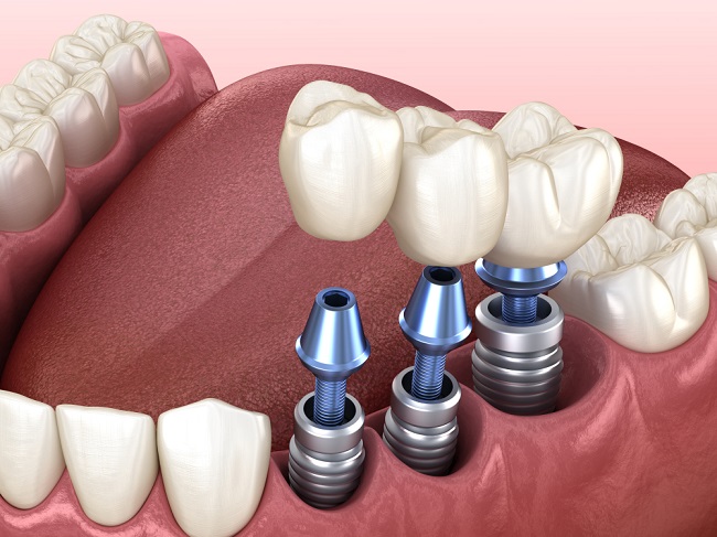  Tuổi thọ tối đa của răng Implant là bao lâu?