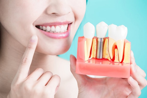 Hướng dẫn cách kéo dài tuổi thọ cho răng implant