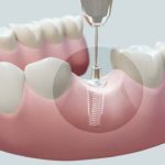 Trụ Implant Straumann Thụy Sĩ là gì và có tốt không?