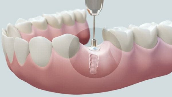 Công nghệ trồng răng implant 4s MỚI và TỐT NHẤT thị trường