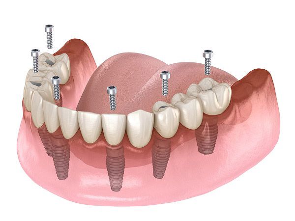 Đặc điểm công nghệ implant 4s