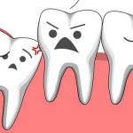 Trồng răng Implant có đau không? Top 3 cách giảm đau hiệu quả