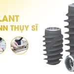 Nhổ răng khôn: 8 trường hợp cần nhổ và 3 lưu ý