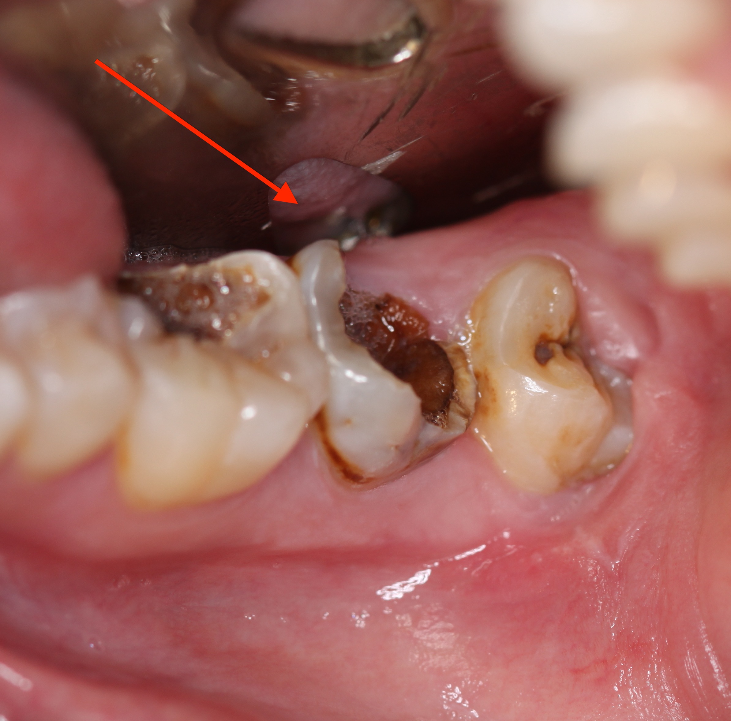 Dấu hiệu bị sâu răng nặng – Bị sâu răng nặng thì phải làm sao?