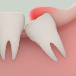 Trồng răng Implant trả góp được không?