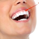 Ưu điểm và nhược điểm khi trồng răng Implant