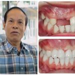 Ưu điểm và nhược điểm khi trồng răng Implant