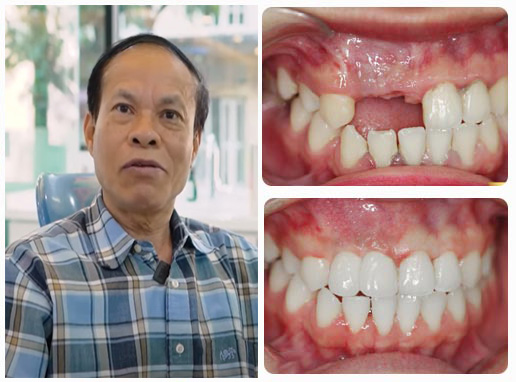 Nên trồng răng bằng cầu răng hay cấy ghép implant