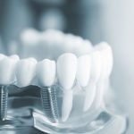 Trồng răng Implant trả góp được không?