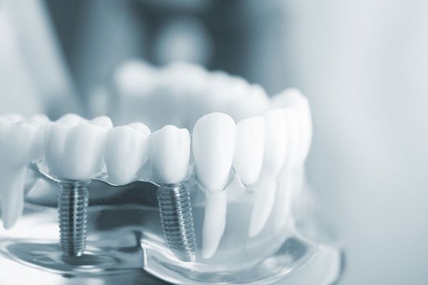 Trồng răng implant tại hà nội