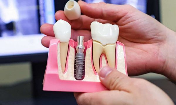 ưu nhược điểm trồng răng implant