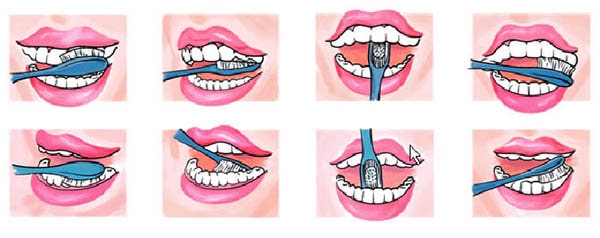 Các bước đánh răng đúng cách sau khi cấy ghép Implant