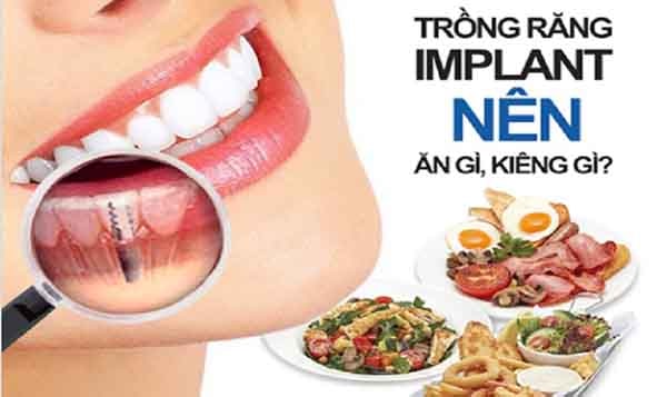 Cấy ghép Implant nên ăn gì và kiêng ăn gì?