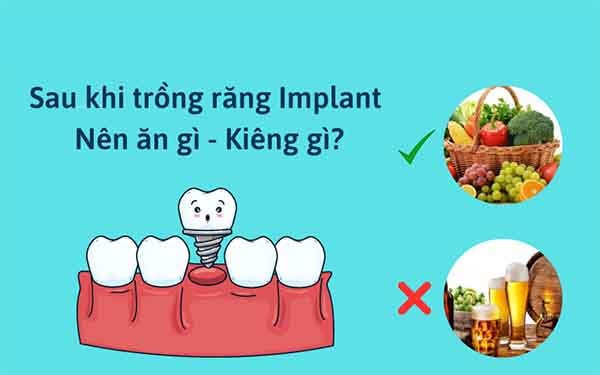 trong rang implant kieng an gi