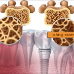 Nâng xoang khi cấy ghép implant áp dụng cho trường hợp nào?