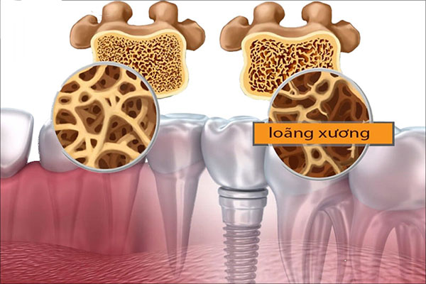 Người bị bệnh loãng xương có trồng răng Implant được không